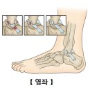 염좌 [sprain]근골격질환 이미지