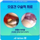 오십견의 원인과 비수술적 치료 이미지