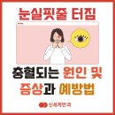 눈실핏줄 터짐 충혈되는 원인과 증상 그리고 예방법 이미지