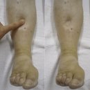 내강한의원 | 압박스타킹이 독이 될 때? 하체 부종, 올바른 치료법을 선택하는 법: 동맥 vs 정맥 vs 림프