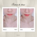 수정위례-D-10 | 위례피부관리 후에스테틱 작은얼굴/얼굴윤광 후기:D