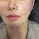 제일탑한의원 | [올타이트 400샷 후기] 강남신사 피부과 얼굴살없는 땅콩형 얼굴, 팔자주름 레이저 추천