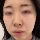 시청역(2호선) | 티타늄 리프팅 한달 찐후기, 서울 시청역 피부과