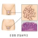 사마귀 이미지