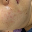 의정부피부관리 트러블 전문케어 피부샵 러브썸뷰티 찐 후기