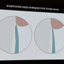 박영민치과의원 | 최소삭제 라미네이트 얼마나 삭제할지 어떻게 결정할까 - 접착치의학회 춘계학술대회 후기(4)