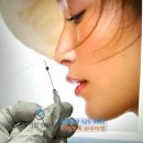 수아연한의원 | 심술보 제거 마리오넷 주름 원리부터 다른 수아연한의원 시술 후기 좋은 이유가 있어요(시술영상)