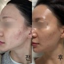 알파 사우나 | 청담피부과 여드름흉터치료 '울트라펄스알파' 1회차 치료후기 (전후사진, 효과, 가격)