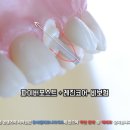 선교정치과기공소 | 치관연장술로 치조골 삭제 및 치은 절제 앞니크라운 교체