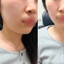 처음처럼성형외과의원 | 캐스팅성형외과 의원 부천 주차 눈밑지 침샘보톡스 미간보톡스 주차 솔직 후기