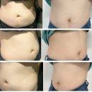 블랙앤드 압구정 | 강남다이어트 압구정다이어트 지방분해 엔드컷 복부지방 타파! (앤드컷 2회차 후기)