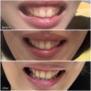 더미소치과교정과치과의원 | [3화]돌출입 교정 거미스마일 킬본교정 6개월차 비교 솔직 후기!(센트럴치과의원 강남점)