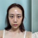 유니풀의원 네이버블로그