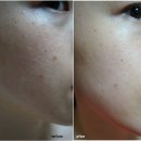 ㈜비아이비 | 여드름제거와 홍조개선에 효과를 경험하신 고객님의 사용인터뷰!!:)