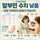 알부민 수치 낮으면 왜 붓나요? 부종·복수·영양상태 해석 이미지