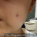 민지네민박 | 갑자기 뚫은 볼 피어싱 2탄(딤플 피어싱, 뺨 피어싱, 보조개 피어싱 후기 / 흉터 &amp; 보조개 유무)