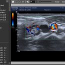 갑상선 결절 초음파 및 세침검사 결과 이미지
