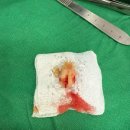 이사랑서울치과의원 | [수유] 사랑이치과 매복사랑니 발치 후기