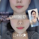 트리니티 유도 | [부산서면피부과] 트리니티리프토닝 리프팅 솔직후기 &amp; 전후비교, 시술 받고 번호 따인 썰😉