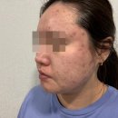 효자한의원 | 부산여드름한의원에서 여드름흉터치료 8회차 내돈내산 찐 후기