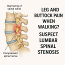 🚶‍♀️걸을 때 다리·엉덩이 통증 있다면? 이미지