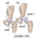 대퇴 골절(Fracture of femur) 근 골격질환이란? 이미지