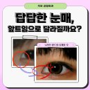 몽고주름 제거, 눈 앞머리 주름 있고 없고 차이 어느정도일까 이미지
