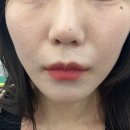 신논현역 리쥬란 다이아 멤버십 피부과에서 리쥬란 에버클 탄생주사 후기