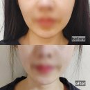 수원 세모아의원 티타늄리프팅+슬림핏주사 제대로 받고온 후기