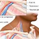 흉곽출구 증후군 (손가락 손저림, 오른쪽 왼쪽 팔저림, 가슴통증) 이미지