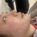 민락역 1,3번출구 E/V 옆 | 강남역 성형외과 실리프팅 리쥬란 prp 수면마취 내돈내산 3주경과 시술후기 다운타임 통증 멍 부작용 등...