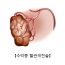 뇌 수막종(Meningioma) 이미지