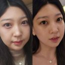 도도네 | 울쎄라피 프라임 효과 통증 붓기 가격 도도쌤 내돈내산 후기