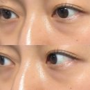 호호호약국 | 35세 백수녀의 눈밑지+지방이식 내돈내산 후기(멍,붓기 2달 변화)