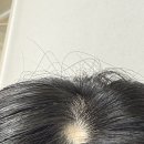 덕경푸드(양심식품) | 여자 원형탈모 치료 피부과 치료 후기｜스테로이드 주사 ｜영양제