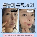 11650-1-10-600 | 정발산역피부과에서 볼뉴머 600샷 받고 온 후기 (효과,통증은?)