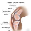 남춘천I.C주유소 | [춘천 도수치료] 오스굿-슐라터병(Osgood–Schlatter disease)이란?