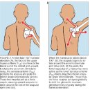 Detecting and Treating Shoulder Impingement Syndrome. 충돌증후군의 진단과 치료 - 정리해야.. 이미지