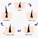 올바른약국 | 미녹시딜 부작용 3가지 및 효과 올바른 사용법 및 약국 가격 구매가이드