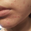 니쥬 | 라니쥬 재생크림 후기, 턱 주변 여드름 이렇게 달라졌어요