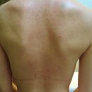 미강세탁 | 등드름 색소침착 연고 레이저 보다 효과 좋았던 미강약침 비용 후기