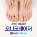레이저 | 연신내 무좀 발톱 관리 스케일링 오니코 레이저 치료 후기