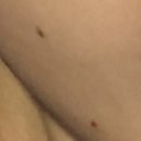 라르떼의원 | [수유 라르떼의원] 편평사마귀, 점 제거 후기