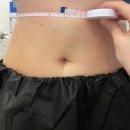 진주성형외과의원 | 진주 다이어트 끝판왕! '썸머브리즈' 복부 S젯 지방분해 주사 리얼 후기 (feat. 뱃살 타파 진행 중🔥)