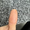 빨간손톱 - 계양구 | [공지] 손톱들림, 손톱빠짐, 손톱뿌리 뽑힌 후 3개월 손톱자람 후기(2) /손톱뽑기 고통기간 찐후기