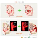 뇌졸중 이미지