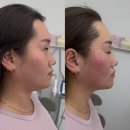 동지메디칼 | 대구 탄력관리 뷰티힐링소 온다리쥬브 후기 리프팅과 콜라겐 동시에 챙기기