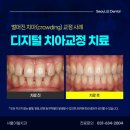 이천다안치과의원 | 이천치아교정, 크라우딩 문제가 있던 환자 후기(ft. 벌어진 치아)