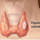 2013.08) 갑상선암 대처법 이미지