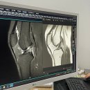 효가1로-R | 전방십자인대 완전 파열 입원 수술 후기 1주차 통증